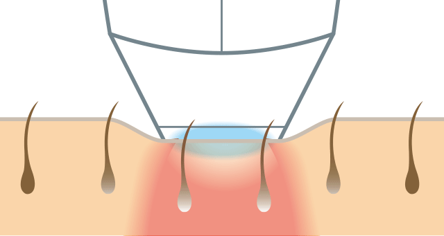 ETハンドピース